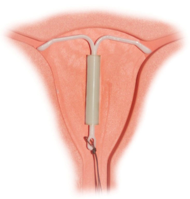 Die Spirale Die Hormonspirale. gemeinfrei